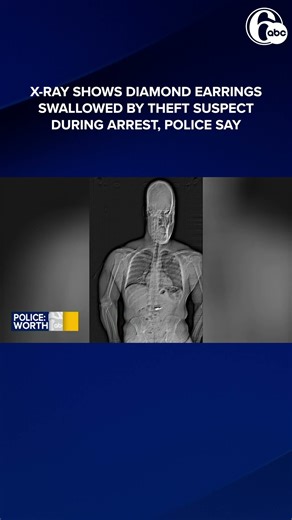 X-RAY SHOWS DIAMOND EARRINGS SWALLOWED BY SUSPECT, POLICE SAY