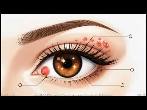 Yeux rouges : causes, symptômes et quand consulter en URGENCE !