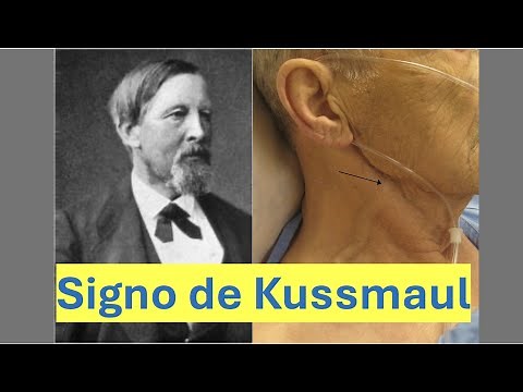 Signo de Kussmaul