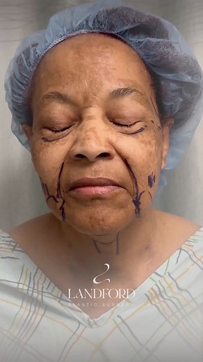 ✨ Deep Plane Facelift & Structural Neck Lift ✨ She wanted definition without looking “done.” Two months post-op, she’s glowing. This procedure lifts the deeper facial layers, tightens the neck muscles, and removes excess skin — giving her natural, long-lasting rejuvenation. ✔️Deep Plane Facelift ✔️Deep Structural Neck Lift Timeframe: 2 months post operation 👩🏽‍⚕️ WILMINA LANDFORD, MD 🏥 PLASTIC SURGEON 📍 Washington DC | Maryland | Virginia 📞 301-235-1900 | Wilmina Landford, M.D.
