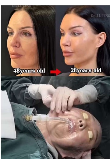 Facelift Surgery for a Younger Appearance