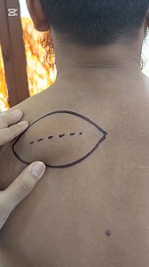 Large Lipoma in Upper back part of chest | Dr. Khaled Hasan Milu