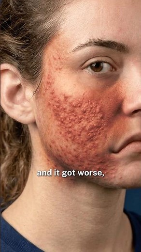 Why Your Fungal Acne Isn’t Improving…