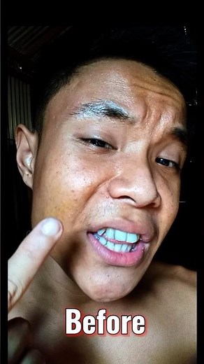 I Was Embarrassed Of My Pimple Skin — Until I Tried This Banana Peel Trick! #skincaretips #skincare