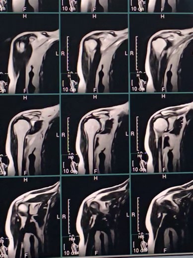 Understanding MRI of the Right Shoulder