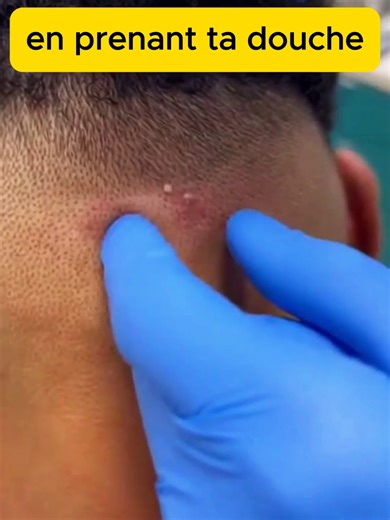 Understanding Folliculitis: Causes and Skin Care Tips
