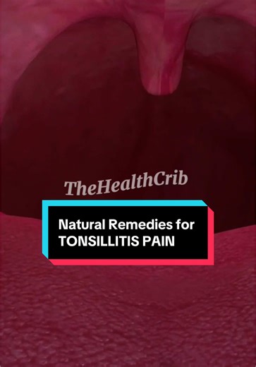 Natural Remedies for TONSILLITIS PAIN #tonsillitis#tonsillitisrecovery#tonsils#tonsilitis