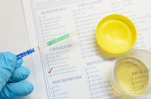 Białko w moczu - normy. Co oznacza podwyższony poziom?