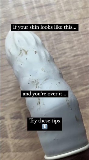 Comedones (commonly known as blackheads and whiteheads) are blockages that occur due to excess oil