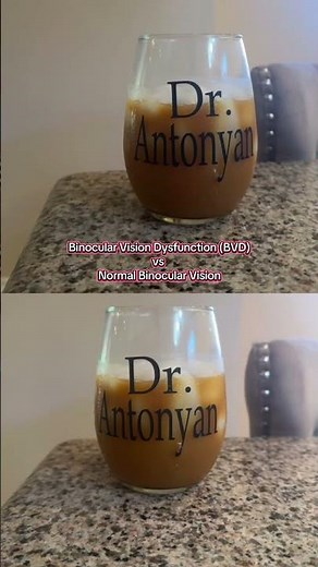 When performing the alternate cover test, the bottom view shows what normal eye alignment looks