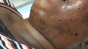 More microneedling from Tauna’s first visit and she share’s how it felt during and after post treatment. Watch this space for when we see Tauna next and her results. You can see the initial VISIA consult here https://www.facebook.com/medispabodyshop/videos/619926182184070/ | MediSpa & Body Shop