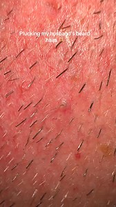 #asmr #sebaceousfilament #multigemini #beard #plucking #beardhairplucking | Jennifer M. Jane