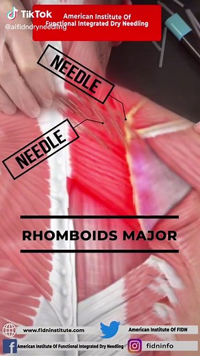 Shoulder Blade Pain Relief through Dry Needling Techniques