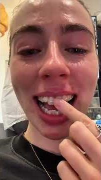 invisalign process (how to get invisalign?)