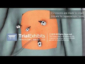 3D Animation of Laparoscopic Cholecystectomy Procedure