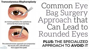 Common Lower Eyelid Surgery Technique that Leads to Pulled Down Eyelids