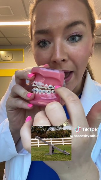 Fixing open bites its complicated! Your orthodontist has to use every tool in the book to get a good result! #openbite #braces
