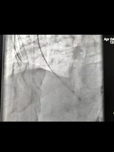 Successful Percutaneous Closure of Ventricular Septal Rupture (VSR) Post STEMI!A high-mortality, often inoperable complication was managed successfully via Device closure.70  y/o female, post… | Hans Ferdinand Dsouza