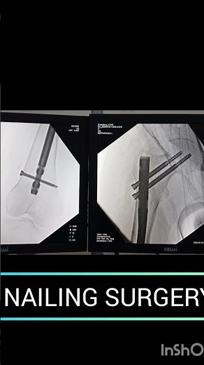 Proximal Femur Nail System PFN #orthoconcepts #anatomy #spinalcord #cervicaldisc