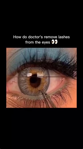 :) on Instagram: "#eyelashremoval – The reel shows a close-up of an irritated eye… until the doctor steps in with steady hands and magnifying lenses. Instead of rubbing or poking, they use precise tools to gently separate the lids, locate the tiny lash hiding inside, and lift it out without touching the eye’s surface. – That satisfying moment when the lash finally slides free is what’s pushing the clip viral today. People never realize how carefully doctors work around the eye — using light, mag