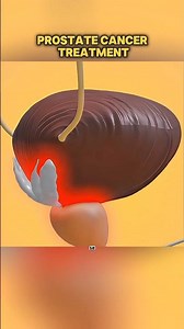 Prostate cancer treatment (3D Animation)