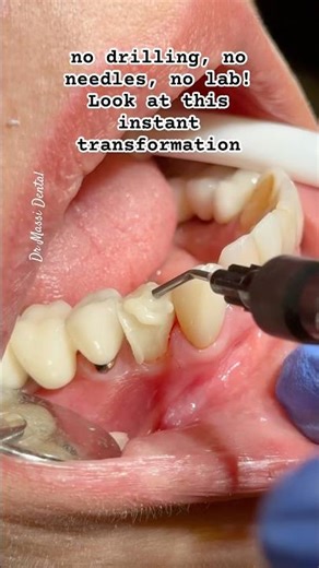 No Crown Needed! Instant Tooth Fix with Bonding — Save Money, Look Great!
