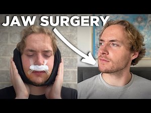 My Jaw Surgery for Sleep Apnea | Before & After 3 Months Post-Op