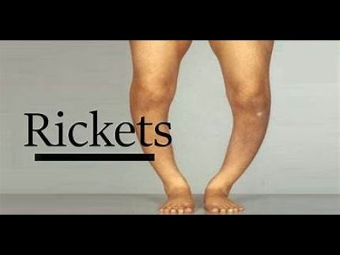 “Rickets: Causes, Symptoms & Treatment Explained!”