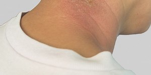 All You Need To Know About Staph Skin Infection, Symptoms And Treatment