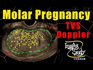 Molar Pregnancy || Hydatidiform Mole || TVS || Doppler || Ultrasound || Case 265