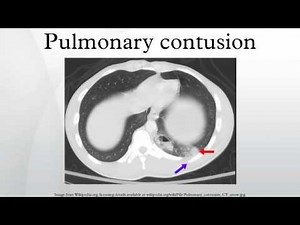 Pulmonary contusion