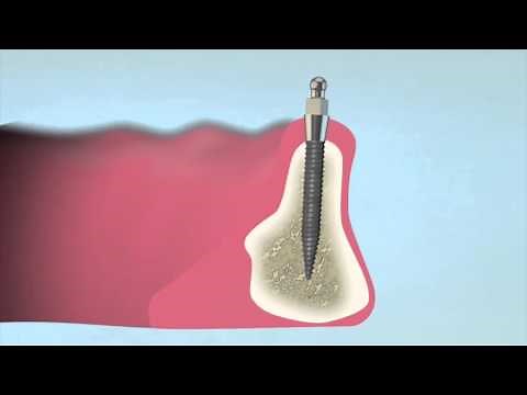 How to Place a 3M™ ESPE™ MDI Mini Dental Implant