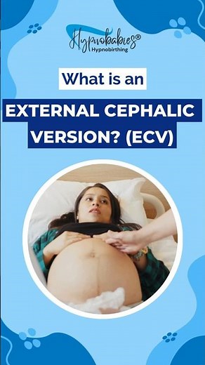 What is an External Cephalic Version?
