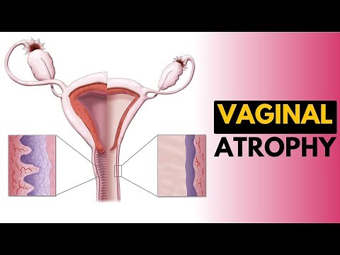Vaginal Atrophy, Causes, Signs and Symptoms, Diagnosis and Treatment.
