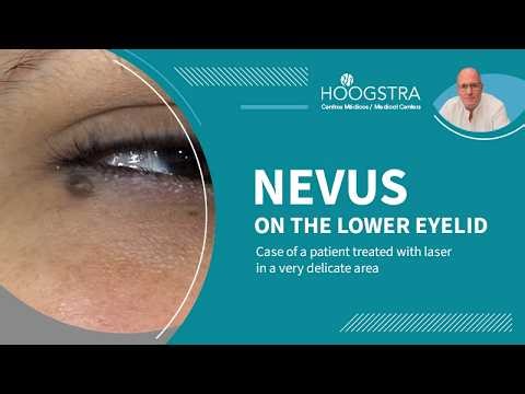 Nevus on the eyelid - Laser removal - 26014b