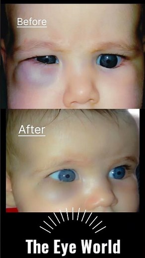 capillary Hemangioma before /after triamcinolone injection