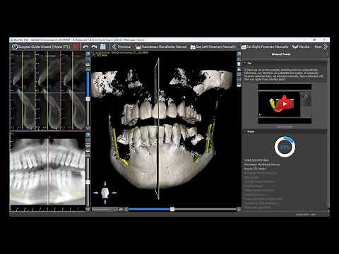 Making Your First Surgical Guide From A to Z