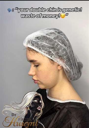 Dr Firuza Huseyni (@dr.firuzahuseyni) - Double Chin Liposuction and Buccal Fat Removal Results