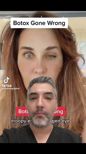 #Botoxgonewrong. What happened and how to fix it. Credit: @Tatiana Rezende thank you for sharing your story. #greenscreen #botoxface #droopyeye #droopyeyelids #fyp #zcenter #drzadeh #losangeles #shermanoaks #medspala #botoxdoctor #badbotox #botched #itgetsbetter