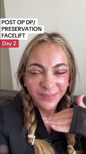 Day 2 post op deep plane facelift preservation style with Dr