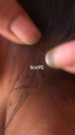 Effective Strategies for Lice Treatment and Prevention