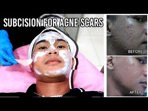 SUBCISION FOR ACNE SCARS | BEST ACNE SCAR TREATMENT: Subcision, Microneedling, TCA Cross & PRP Ph