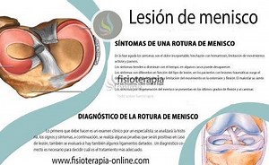 Lesión y rotura de Menisco: Consejos y tratamiento fisioterapéutico