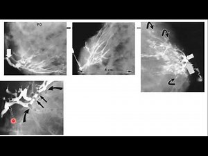 Galactography ( Breast Ductography), an underused investigation