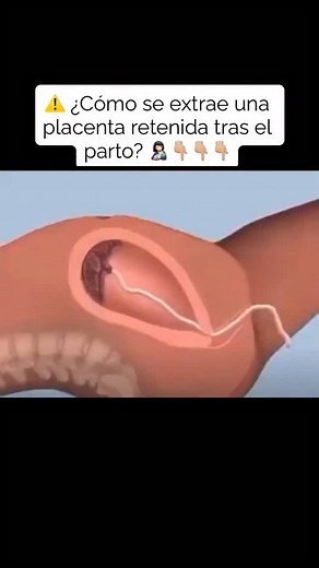 ⚠️ La extracción manual de placenta es un procedimiento obstétrico que se realiza cuando la placenta no se expulsa espontáneamente tras el parto vaginal, lo que ocurre en aproximadamente 0.6–1.5% de los partos. 📚 Consiste en introducir una mano estéril en la cavidad uterina, generalmente bajo anestesia regional o general para minimizar el dolor y facilitar la relajación uterina, y separar cuidadosamente la placenta de la pared uterina siguiendo el plano de clivaje natural. 📋 Entre los factores