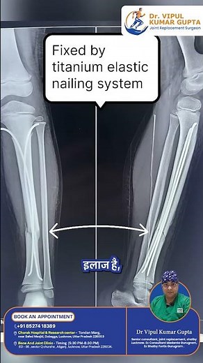 Is Your Tibia Bone Fractured? Here's What You Need to Know for a Safe and Speedy Recovery!