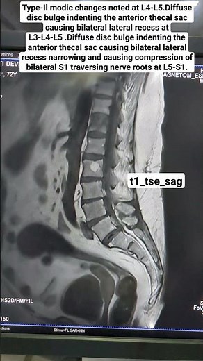MRI Spine Showing Diffuse disc bulge t1_tse_sag Sequence #beginners