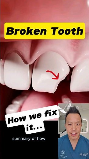 Broken Front Tooth? Here’s How Dentists Restore Your Smile! #dentallan #dentist #shorts