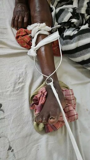 Steinmann pin skeletal traction