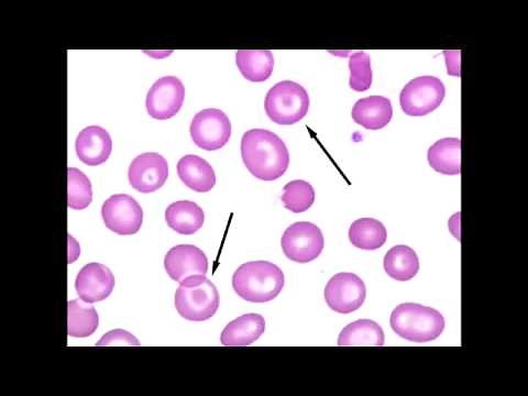Teardrop Cell (Dacrocyte) & Target Cell (Codocytes)